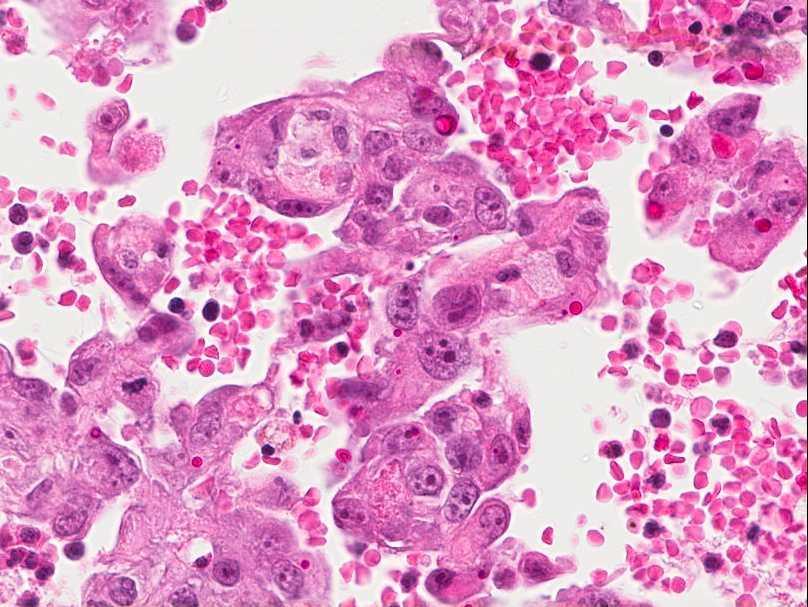 Hemangiosarcoma TUMOURS OF THE CARDIOVASCULAR SYSTEM