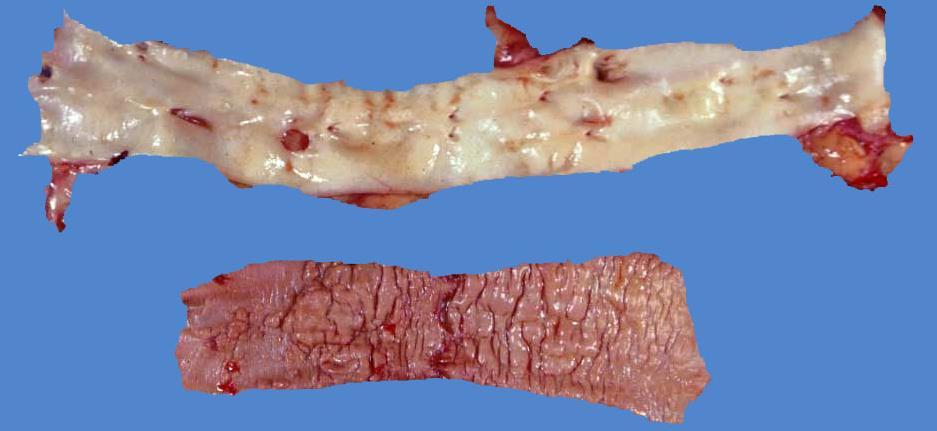 of the artery: Loss of arterial elasticity Luminal narrowing Arterial