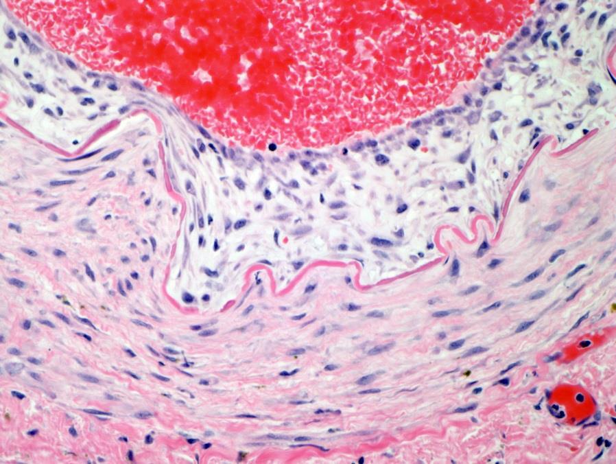 Often become mineralized Histologically, fibrosis in the intima and smooth