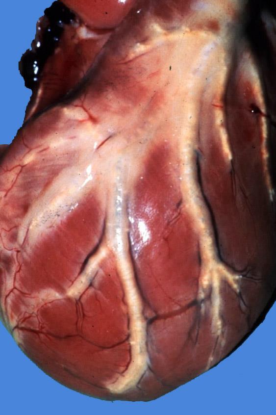 VASCULAR SYSTEM DEGENERATIVE DISEASES OF ARTERIES Atherosclerosis Dog Refers to the formation of cholesterol plaques (= atheromas) in the intima and media of arteries Large elastic arteries and
