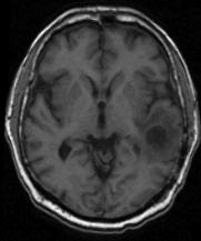 338 O. Clatz et al. Element Model (FEM) initialized from the patient MRIs.