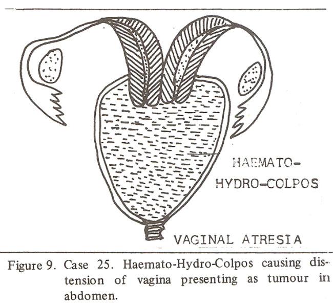 Four cases of imperforate hymen noticed in childhood developed spontaneous opening of hymen (2 were sisters).