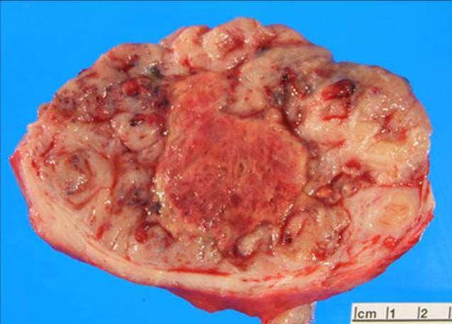 Leiomyosarcoma A 57 year-old lady, presented to GYN clinic complaining of postmenopausal bleeding, and underwent hysterectomy.