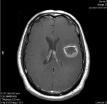 Figure 5. Issues Relating to Bevacizumab Therapy for Patients with Glioma A C A. This patient was a 52-year-old male with aphasia and a seizure. B. This image was obtained after radiation therapy and temozolomide followed by 3 cycles of adjuvant temozolomide.