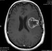 MRI was performed again 3 months after his second surgery. He was still on bevacizumab, but now exhibited increasing steroid requirement and worsening speech function.