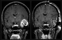 an option for relatively few patients with high-grade glioma due to the poorly defined borders of these infiltrative lesions.