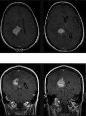 Figure 3. MRIs of a 58-Year-Old Woman Previously Diagnosed with Demyelinating Disease should therefore be performed when there is reasonable assurance of protecting against neurologic deficit.