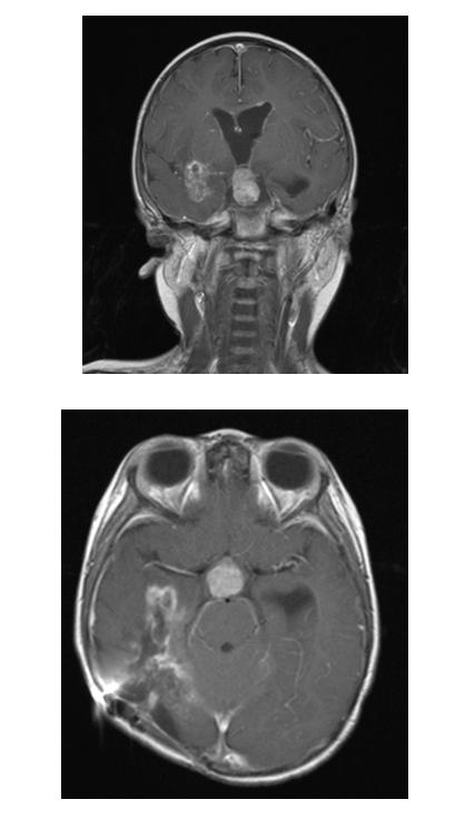 Dramatic early radiographic and clinical response in a 3-year old girl with a glioblastoma multiforme with an ETV6-NTRK3 fusion Baseline After 2 cycles Courtesy