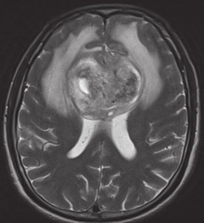 Ho 2, MBBS, FRANZCR, Wilfred CG Peh 1, FRCP, FRCR Fig. 1 Axial non-enhanced CT image of the brain. 2a 2b 2c Fig.