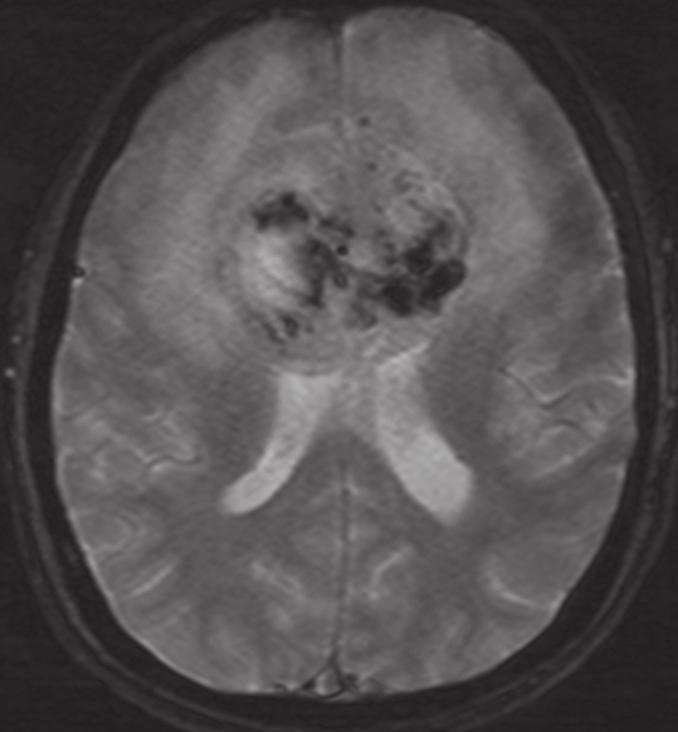 CASE PRESENTATION A 54-year-old man presented with change in behaviour, nocturnal enuresis, abnormal limb movement and headache