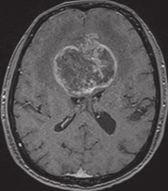 1) and magnetic resonance (MR) imaging (Figs. 2a c) of the brain show? What is the diagnosis?