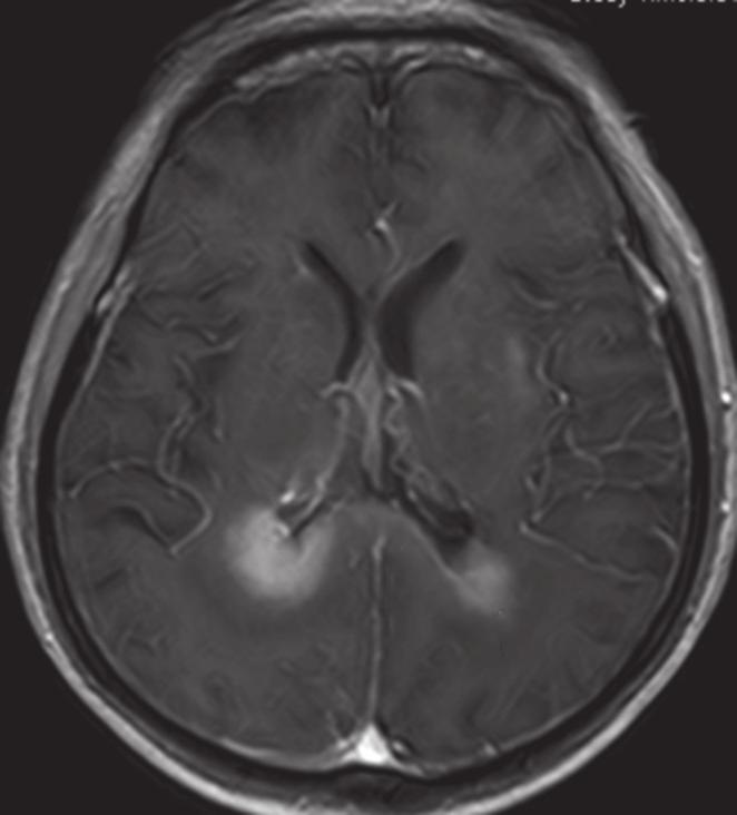 IMAGE INTERPRETATION Unenhanced CT of the brain (Fig. 1) shows a heterogeneous lesion involving both frontal lobes, which crosses the midline at the genu of the corpus callosum.