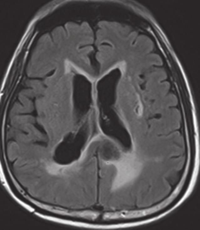 4a 4b Fig. 4 Brain metastasis in a 72-year-old man with a history of known colonic malignancy.