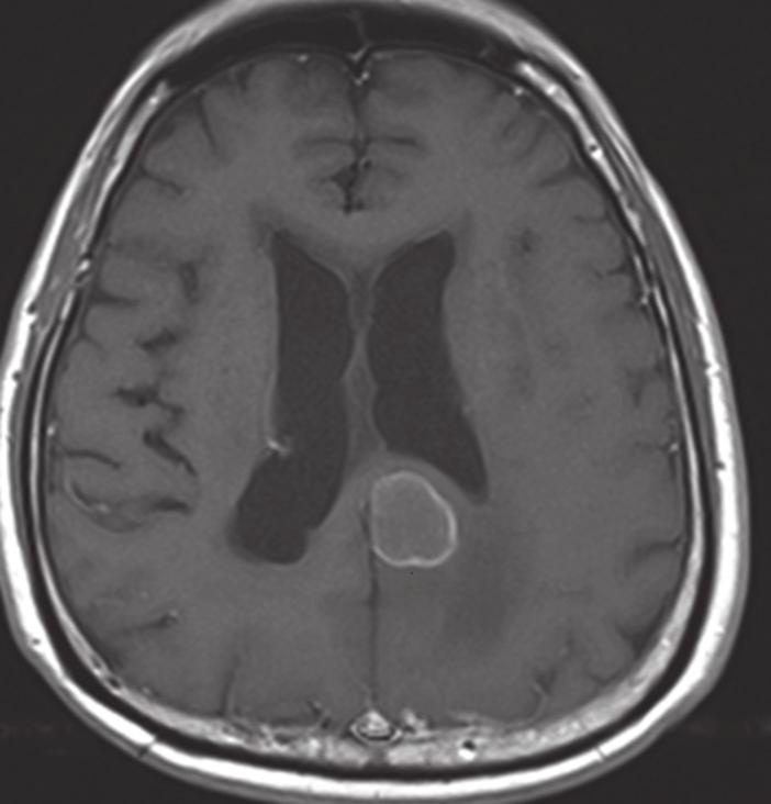 (b) Axial enhanced T1-W MR image shows peripheral enhancement of the lesion (white arrow). 5a 5b Fig. 5 Meningioma in a 58-year-old man presenting with right facial droop and left lower limb weakness.