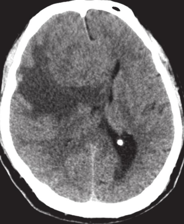(b) Axial T2-W MR image shows a cerebrospinal fluid cleft (arrows) between the lesion and adjacent brain parenchyma, indicating the extra-axial location of the tumour.