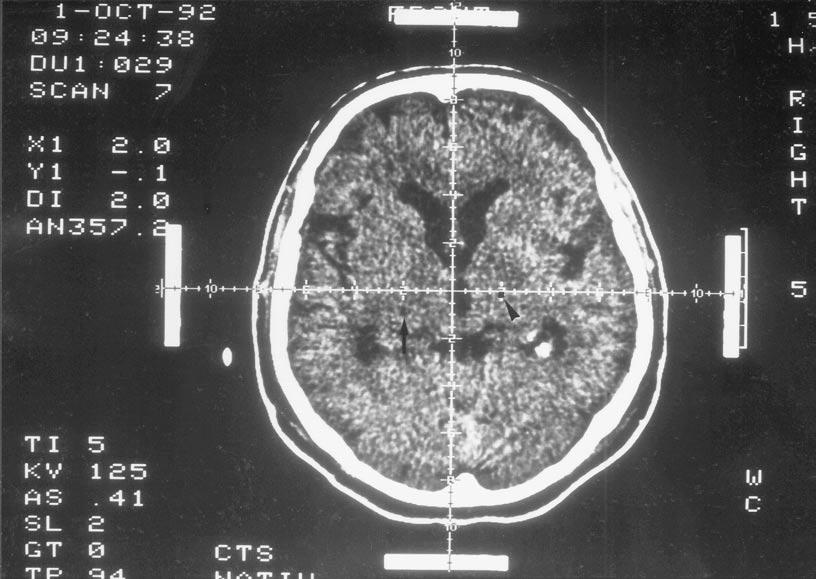 CT-Guided Stereotaxy: First 10-year experience 225 b) Fig. 3b. Functional stereotaxy in a patient with Parkinson s disease.