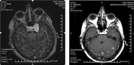 Radiological improvement was noted in 218(87%); stable disease in 138(55%) and 80(32%) cases showed more than 30% reduction in size after 6-12 months of follow-up.