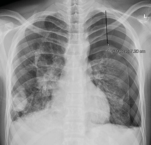 In the local hospital, he was diagnosed with a right-sided pneumothorax and treated with a chest tube.