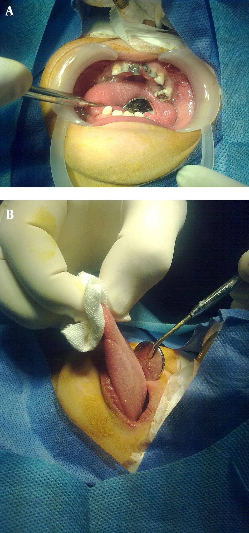 Figure 4. Panoramic View of the Teeth and the Jaws Showing Preoperative Status Figure 5. A Sample of Intraoral View (Mandibular Left Side) Following Dental Treatment Under G.A Figure 3.