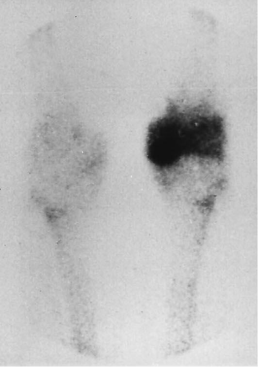 Fig. 1 Bone scintigraphy in the acute phase of
