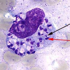 Tissue Diagnosis skin, spleen, bone marrow Infected Macrophage with