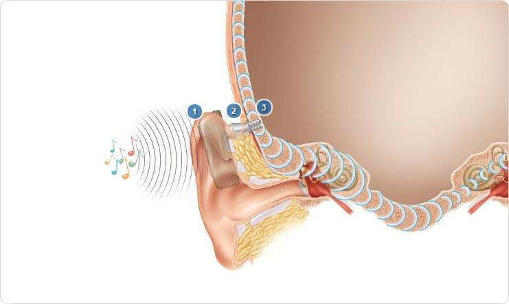 BAHA how it works 1. A sound processor picks up sound vibrations. 2. An abutment is attached to the sound processor and the implant.