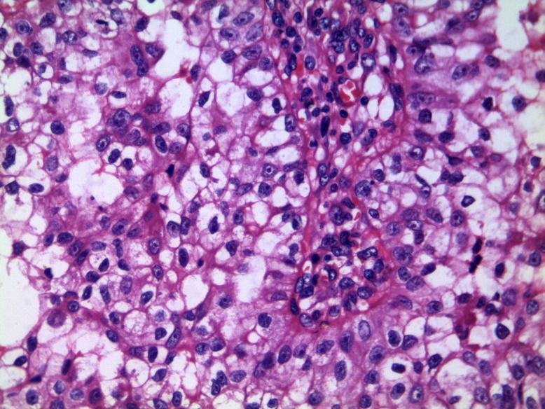 Figure 3: Microscopic picture of renal mass showing clear cell type of Renal Cell Carcinoma with papillary architecture. Figure 4: Microscopic picture of skin nodules consistent with leiomyomas.