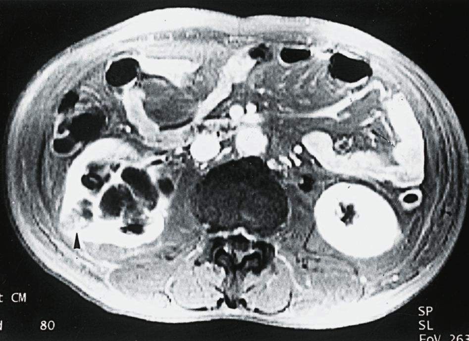 system. Fig. 2 MRI of the right kidney showing 1 cyst with soft tissue in the septum (arrowhead).