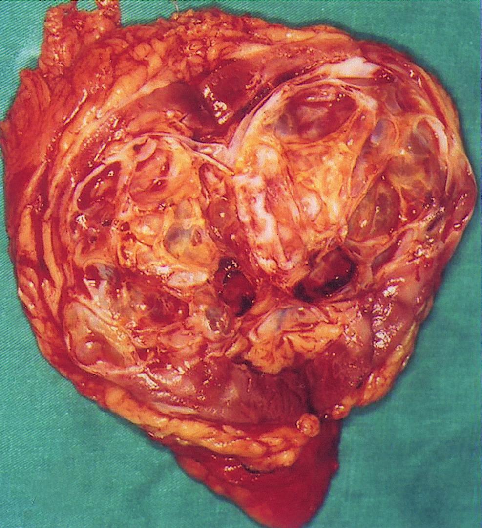 The cystic mass was irregular in contour, and there was a suspicious nodular lesion inside the cyst on