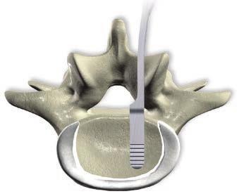 Surgical Technique 6b. Distraction using a distractor Required instruments 389.101 Distractor for Plivios Place the distractor blades in the intervertebral disc space laterally to the epidural space.
