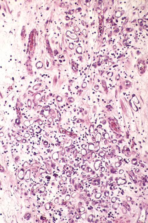 Appearance of malignancy Tubules sometimes