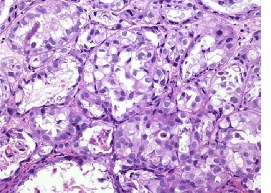 DD Clear Cell Adenocarcinoma Mixed papillary, cystic tubular, solid, diffuse Prominent