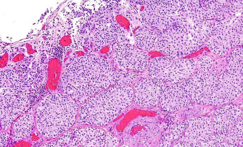 DD Nested tubular variant of Urothelial Carcinoma Admixed typical urothelial carcinoma More irregular nests of