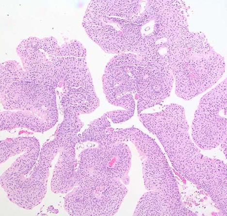 DD Papillary Urothelial carcinoma Lined by stratified layer of urothelium