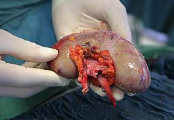 Etiology/Pathogenesis Injury of Urothelium Displacement of renal tubular