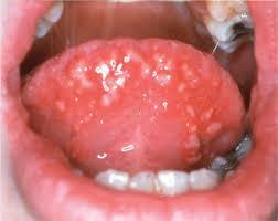 recurrent painful oral ulcers Multiple