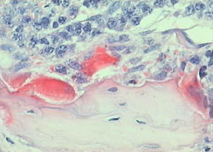 Bone Destruction in Multiple Myeloma Bone Lesions Myeloma cells Osteoclasts Fractures Mechanism