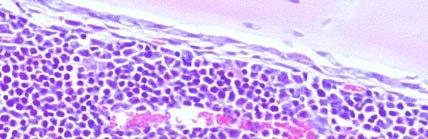 Osteolytic Bone Disease in Breast Cancer Bone Metastasis Breast Cancer Osteoblast number