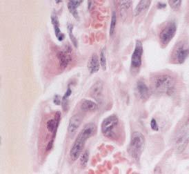 Breast Cancer - Osteolytic Disease