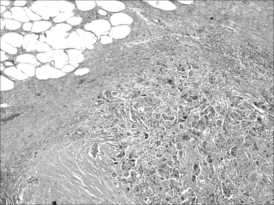 Blood vessels inflammation Ingrowth of fibroblasts & stroma Common Sites of Metastasis General Modes of Metastasis carcinoma