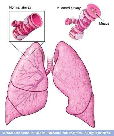 Asthma Asthma is a condition in which your airways narrow, swell and produce extra mucus. This can make breathing difficult and trigger coughing, wheezing and shortness of breath.