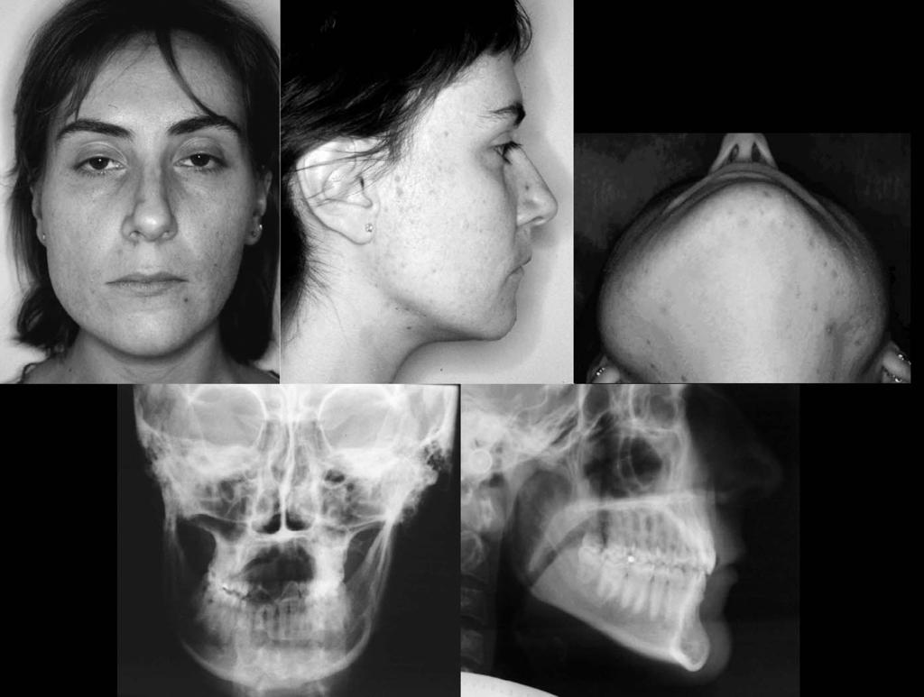 MIDLINE MANDIBULAR OSTEOTOMY IN AN ASYMMETRIC PATIENT 1009 Figure 1. Pretreatment facial photographs and radiograph. mandible and a nearly correct position of the left one.