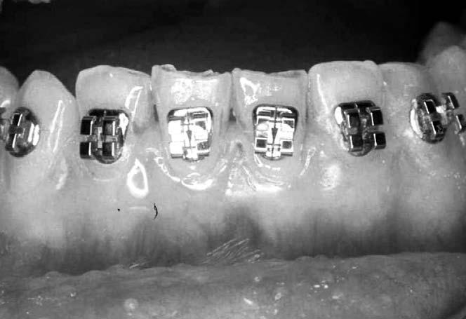 To obtain these surgical results, the dental arches had to undergo presurgical orthodontic treatment. Apart from leveling and aligning the teeth, the orthodontist had two specific goals.