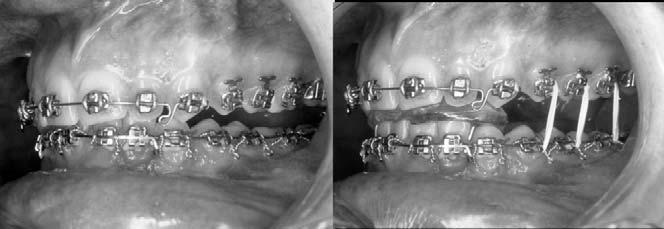 (Figure 11). DISCUSSION Various authors have used mandibular midline ostectomy to treat mandibular excess.