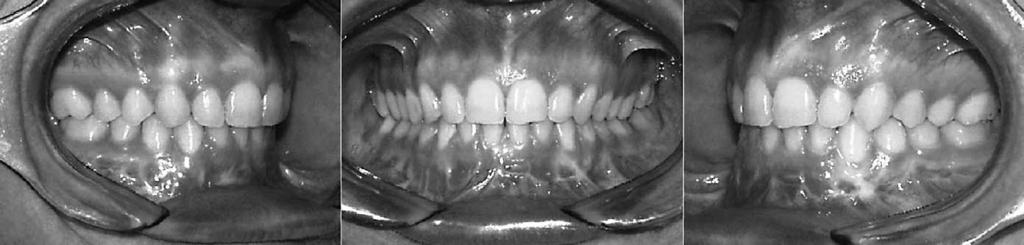 MIDLINE MANDIBULAR OSTEOTOMY IN AN ASYMMETRIC PATIENT 1013 Figure 10. Posttreatment intraoral photographs. ating a lateral left open bite to correct the vertical asymmetry.