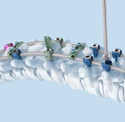 MATRIX Spine System Deformity A Solution for Simple and Complex Spine Pathology