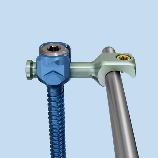 Transverse Bar Attachment (for monoaxial screws only) The transverse bar provides an extension to the monoaxial screw in situations where the rod contour or patient anatomy prevents a direct