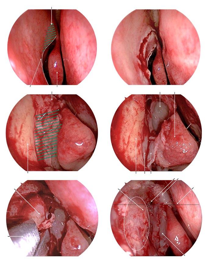 10 Hands-On Dissection Guide on Advanced Endonasal Endoscopic Sinus Surgery E a W b R T c W d W E ER W W e Fig. 2.4a f Endonasal dacryocystorhinostomy. a. Preoperative endoscopic view (0 -HOPKINS scope).