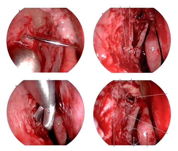 Step 1: Dacryocystorhinostomy (DCR) 11 W g h E R T E i Fig. 2.4g j Endonasal dacrycystorhinostomy. g. Endoscopic view following incision of the lacrimal sac.