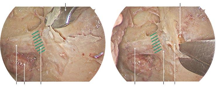 Septa of the sphenoid sinus adhering to the optic nerve canal are subtotally removed. The posterior 1 cm of the lamina papyracea at the orbital apex is removed exposing the optic nerve tubercle.
